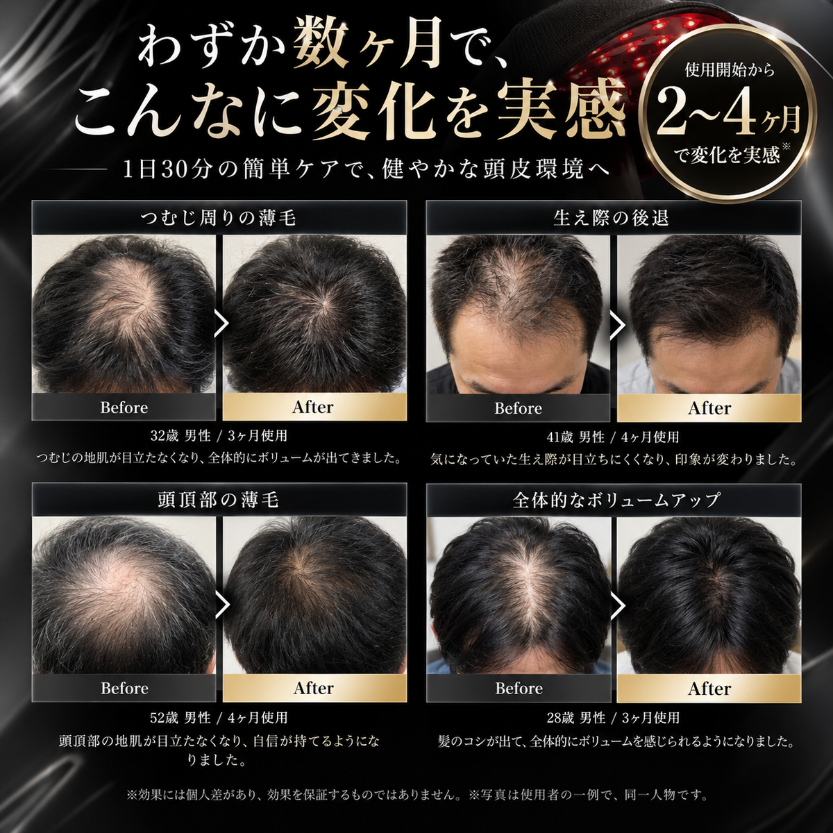 SCALUMI 赤色LED育毛キャップ